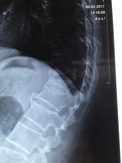我院骨四科成功开展一例脊柱陈旧性骨折角状后凸矫形手术(图1)