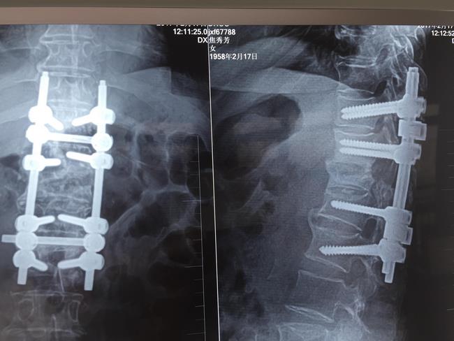 我院骨四科成功开展一例脊柱陈旧性骨折角状后凸矫形手术(图3)