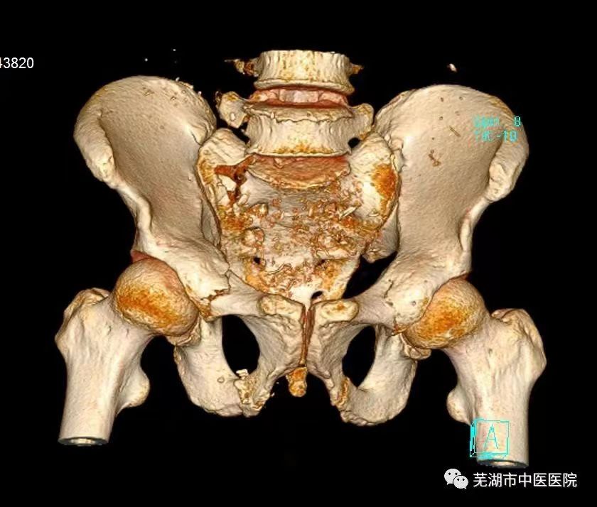 【新技术】芜湖市中医医院创伤骨科三科在全市率先开展经皮微创置钉技术治疗骨盆骨折(图1)