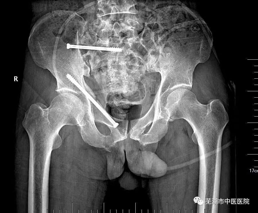 【新技术】芜湖市中医医院创伤骨科三科在全市率先开展经皮微创置钉技术治疗骨盆骨折(图2)