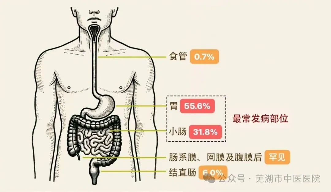狡猾的“隐形杀手”——胃肠间质瘤（GIST）(图1)