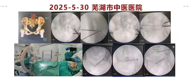 党建引领业务 创新技术突破——我院创伤骨科三科党支部成功开展首例STARR外架微创复位术治疗老年复杂骨盆骨折(图1)